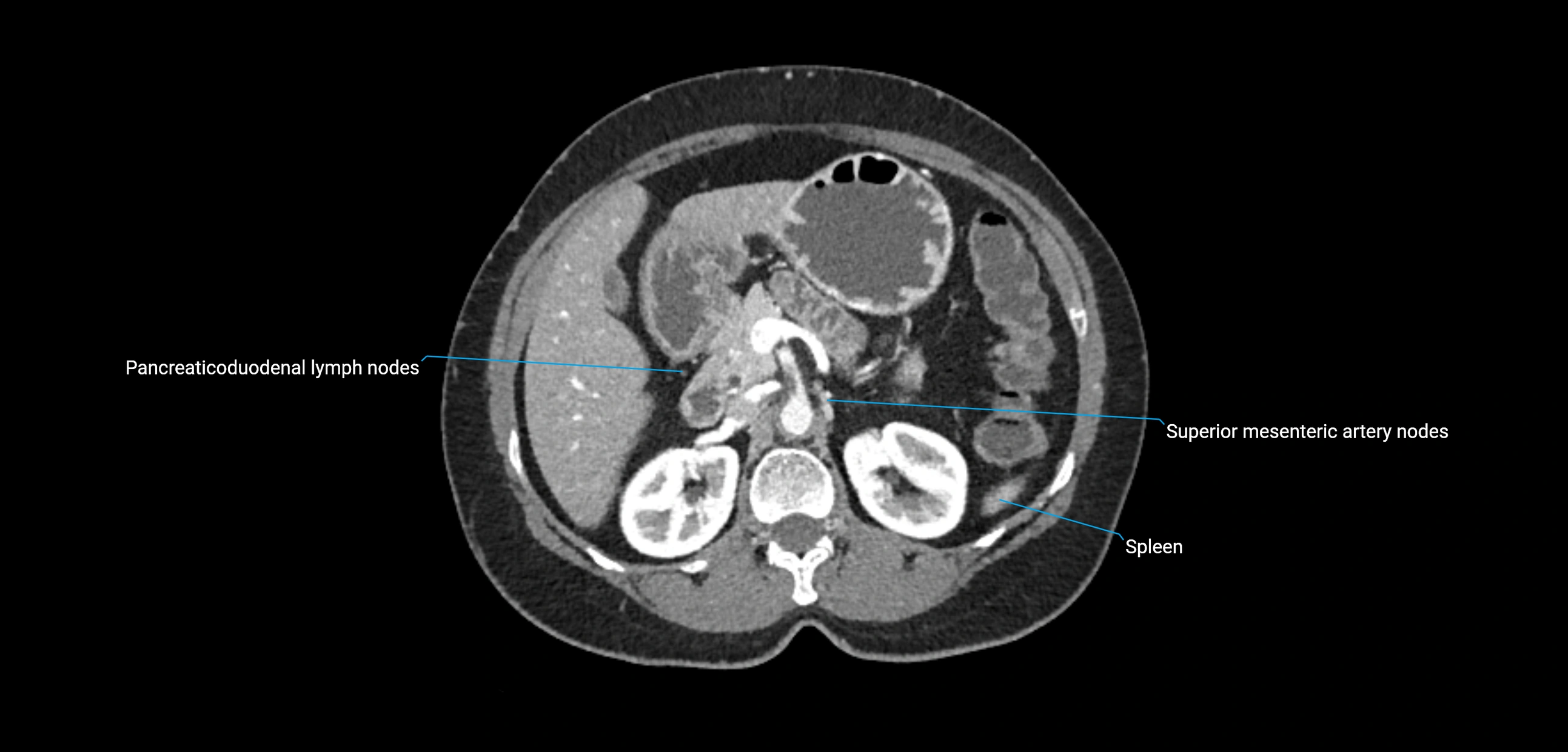 CT ct abdominal lymph nodes  axial cross sectional anatomy  enchanced radiology image -img-00002-00162.webp